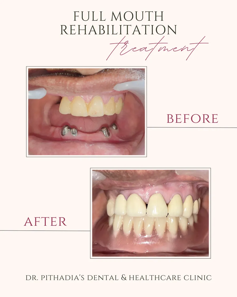 Full Mouth Rehabilitation dental transformation in Kharghar, Navi Mumbai