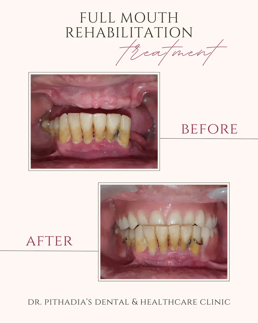 Full Mouth Rehabilitation before and after at Dr. Pithadia's Clinic, Kharghar