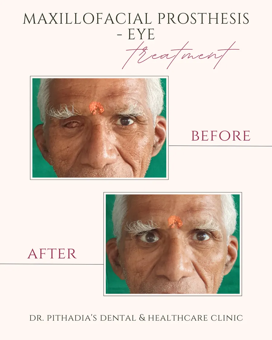 Maxillofacial Prosthesis Eye treatment transformation at Dr. Pithadia's, Navi Mumbai