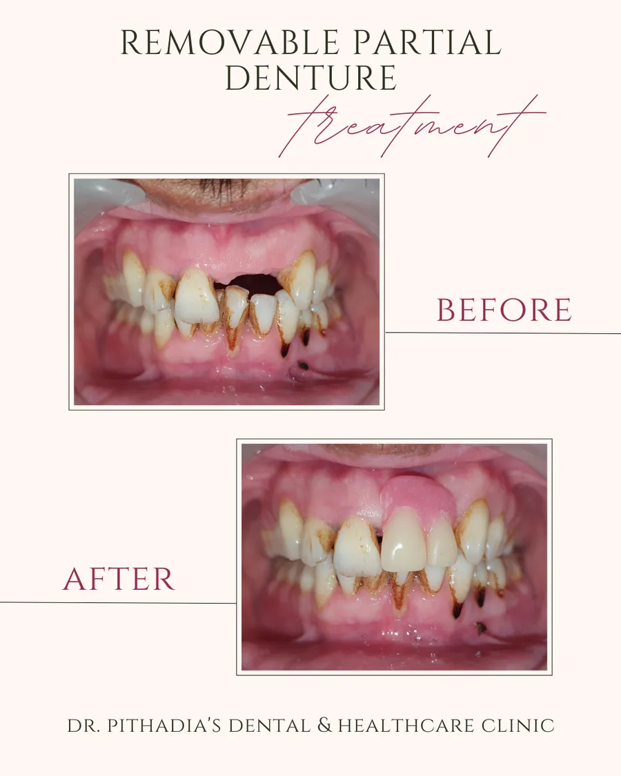 Removable Partial Denture dental transformation at Dr. Pithadia's Clinic, Kharghar