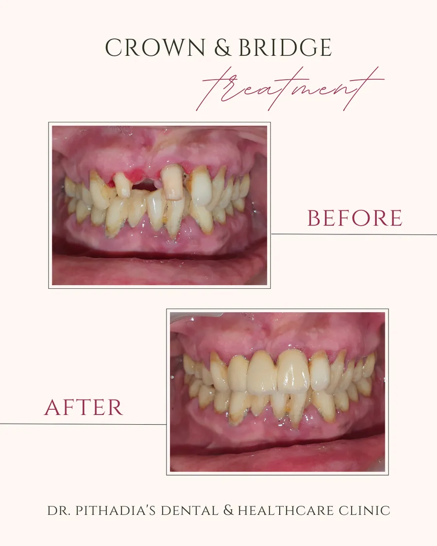 Crown & Bridge dental transformation in Kharghar, Navi Mumbai