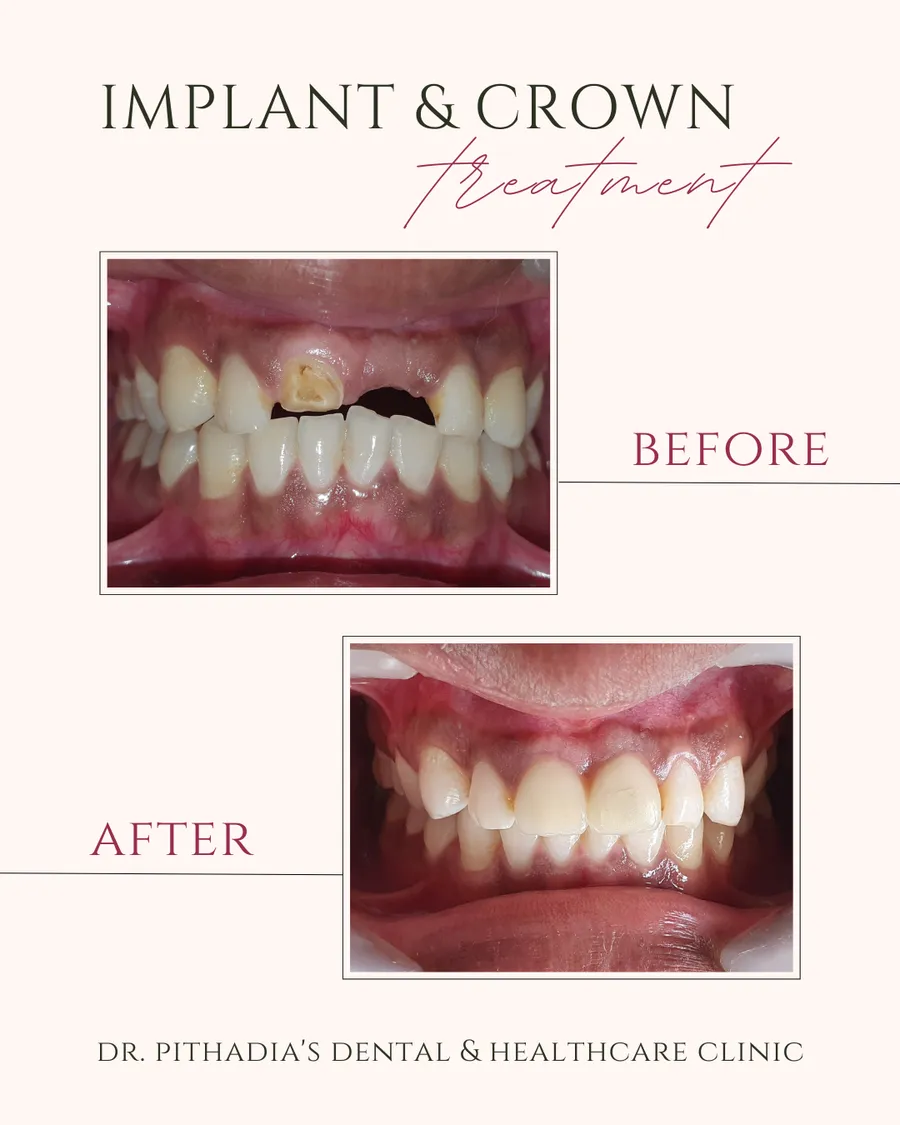 Implant & Crown dental transformation in Kharghar, Navi Mumbai