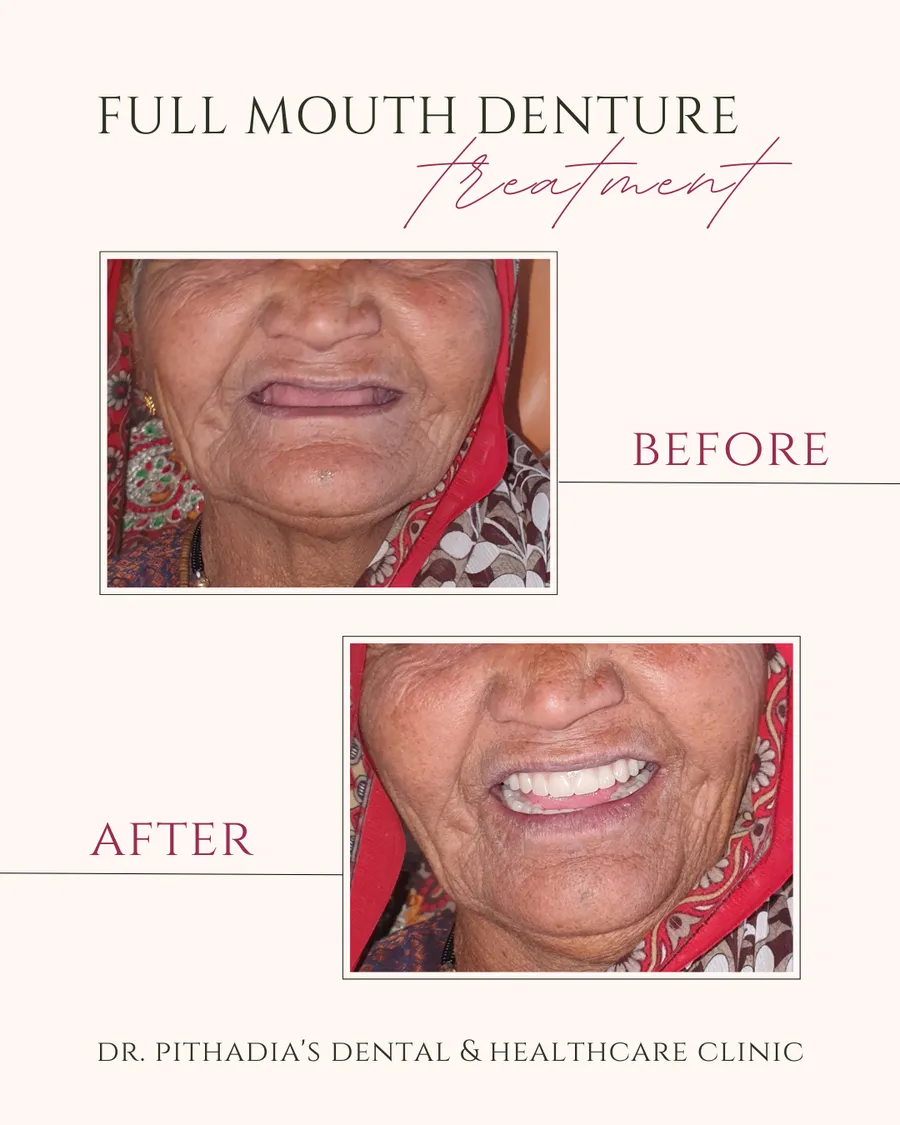 Full Mouth Denture transformation in Kharghar, Navi Mumbai