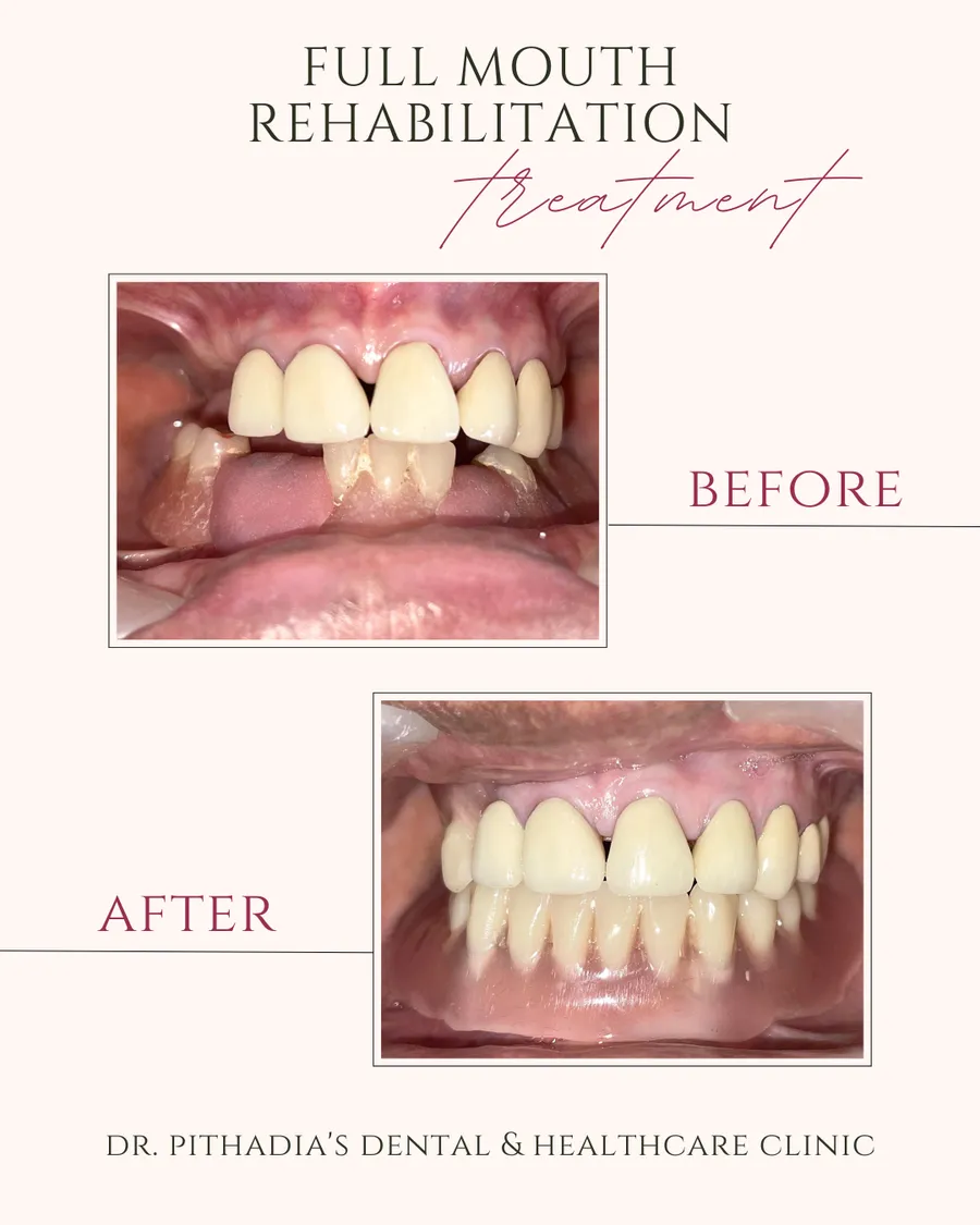 Full Mouth Rehabilitation transformation in Kharghar, Navi Mumbai