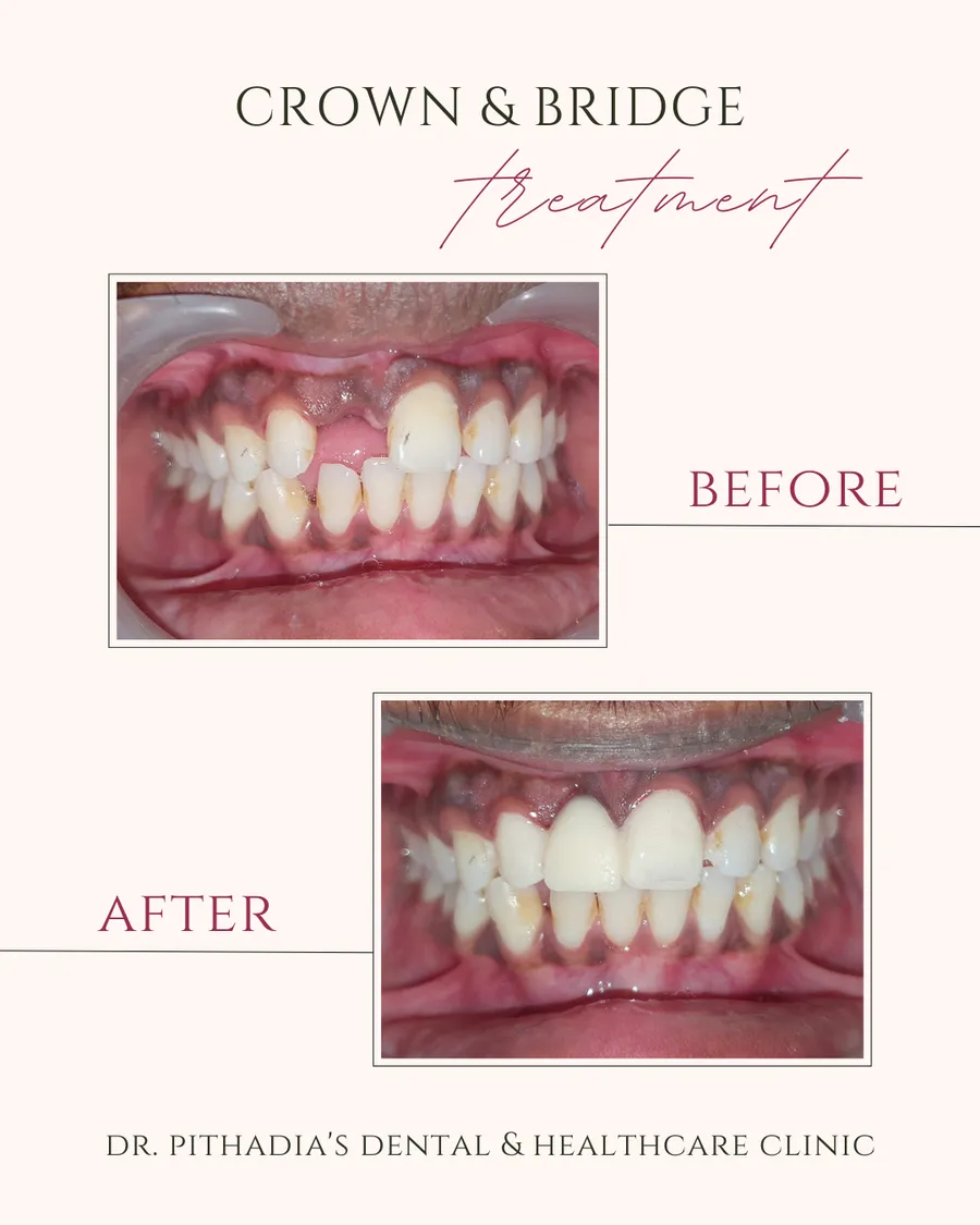 Crown & Bridge treatment transformation in Kharghar, Navi Mumbai