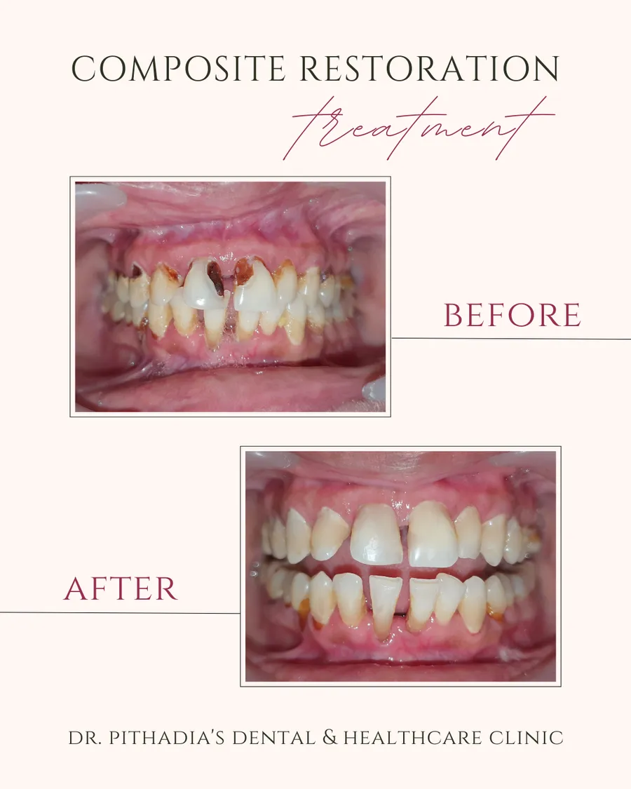 Composite Restoration dental transformation in Kharghar, Navi Mumbai