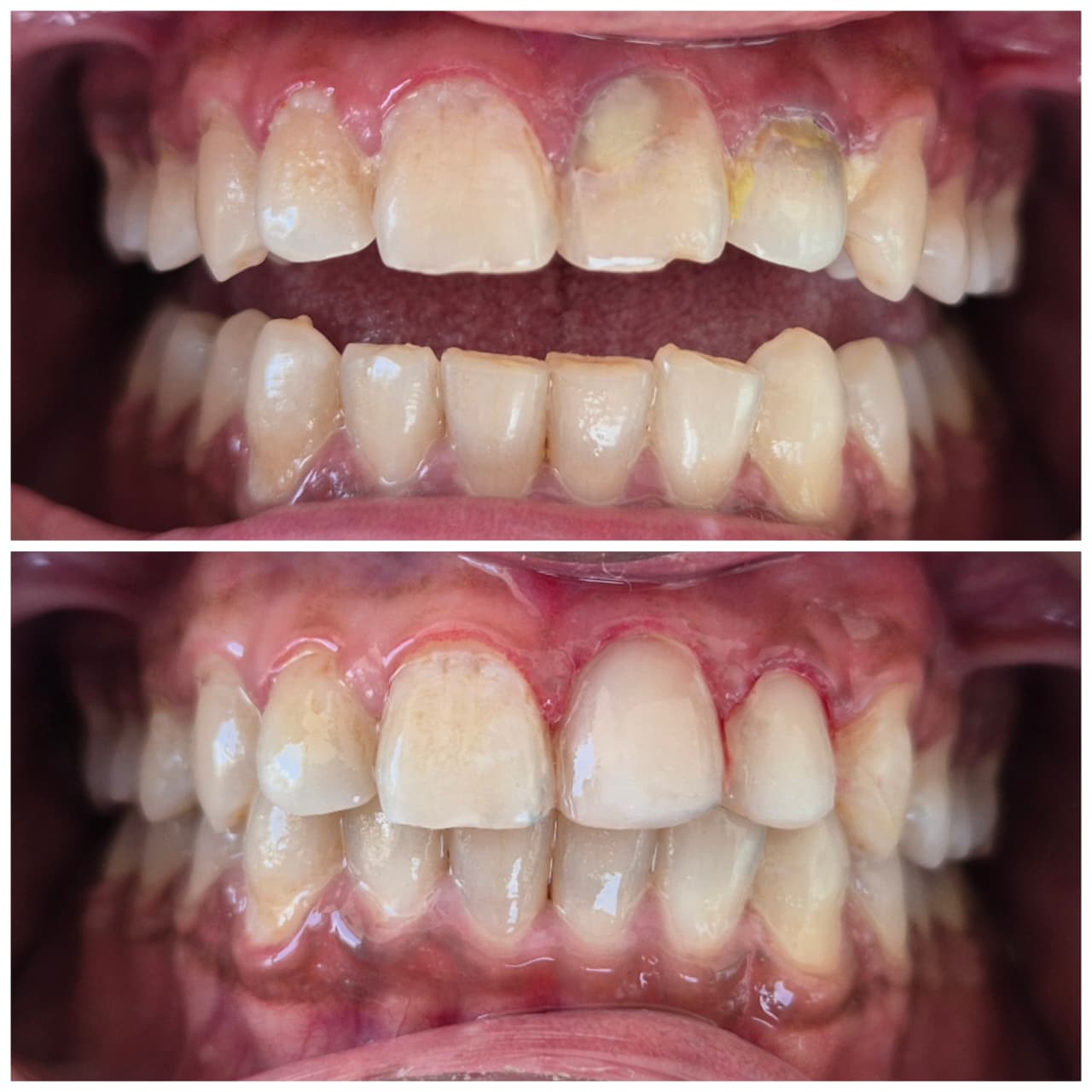 A Front Tooth Cavity, Fixed With Composite Filling: A Sector 14, Kharghar Case Study
