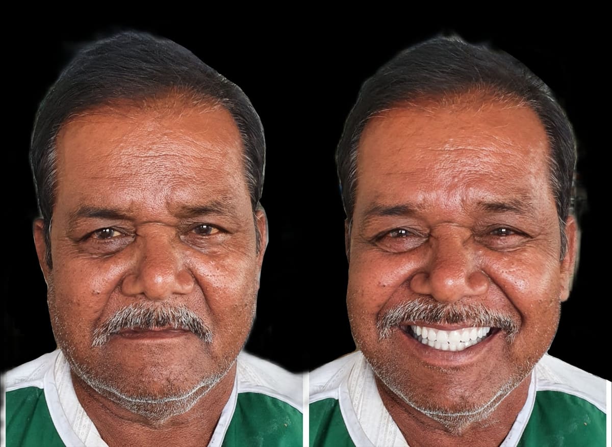 Couldn't Chew Properly? An Implant-Supported Overdenture Case Study From Sector 14, Kharghar